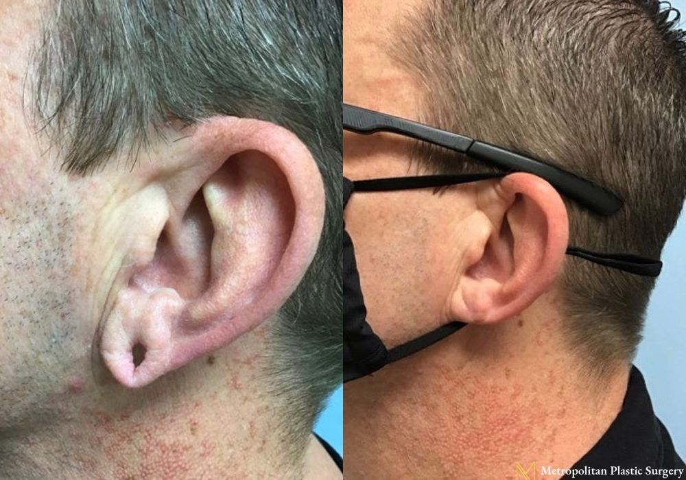 Earlobe Surgery - Case 120