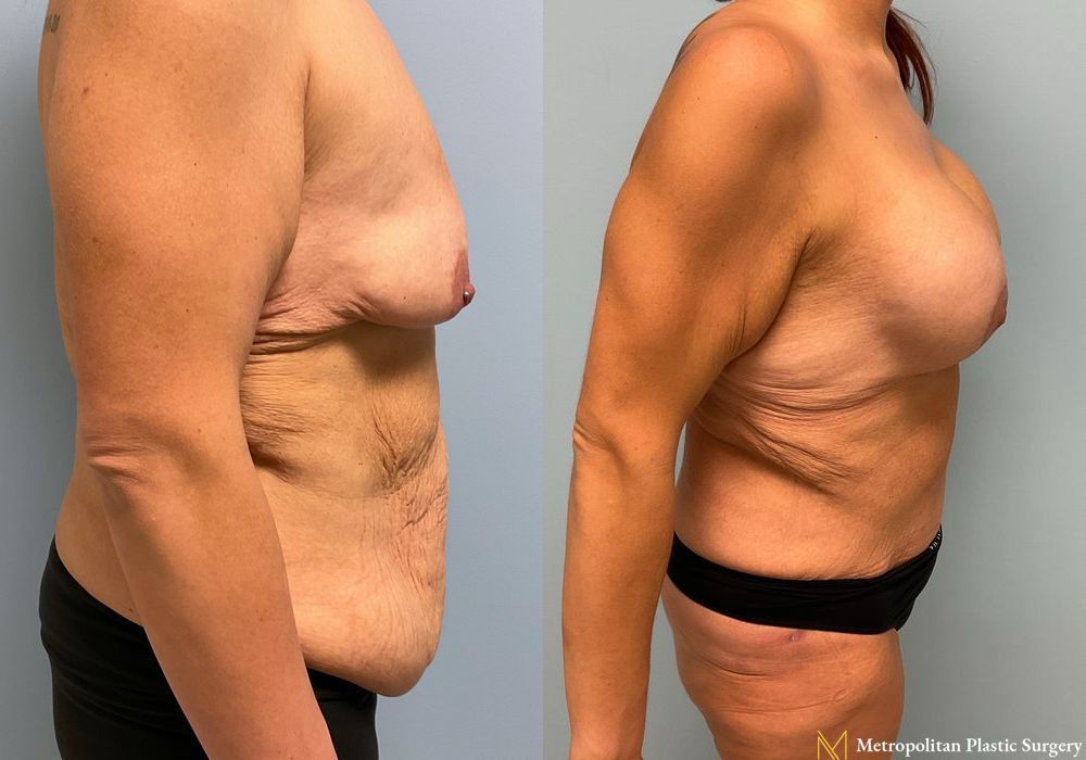 Abdominoplasty - Case 69