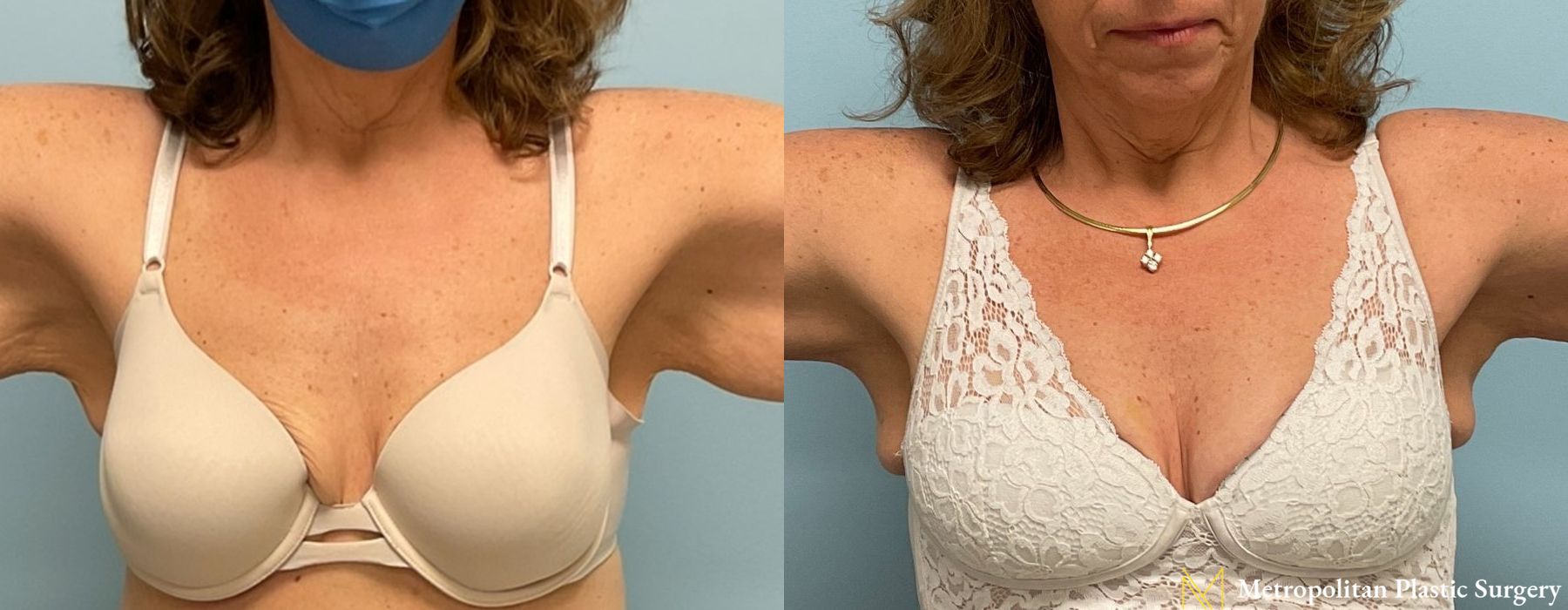 Brachioplasty - Case 77