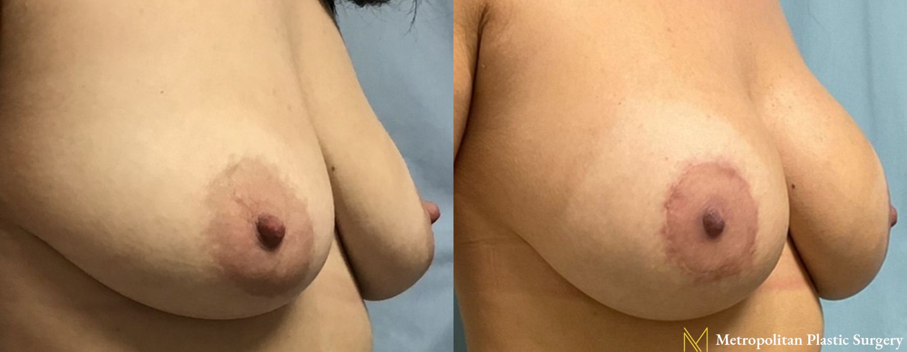 Breast Lift with Implants - Thumbnail 2