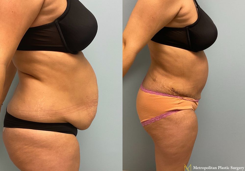 Abdominoplasty - Case 68