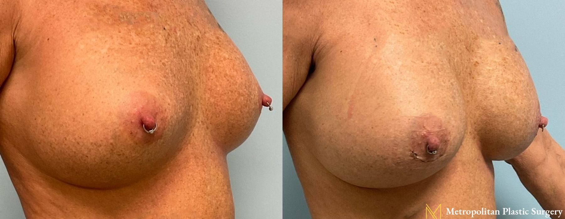 Breast Augmentation - Case 95