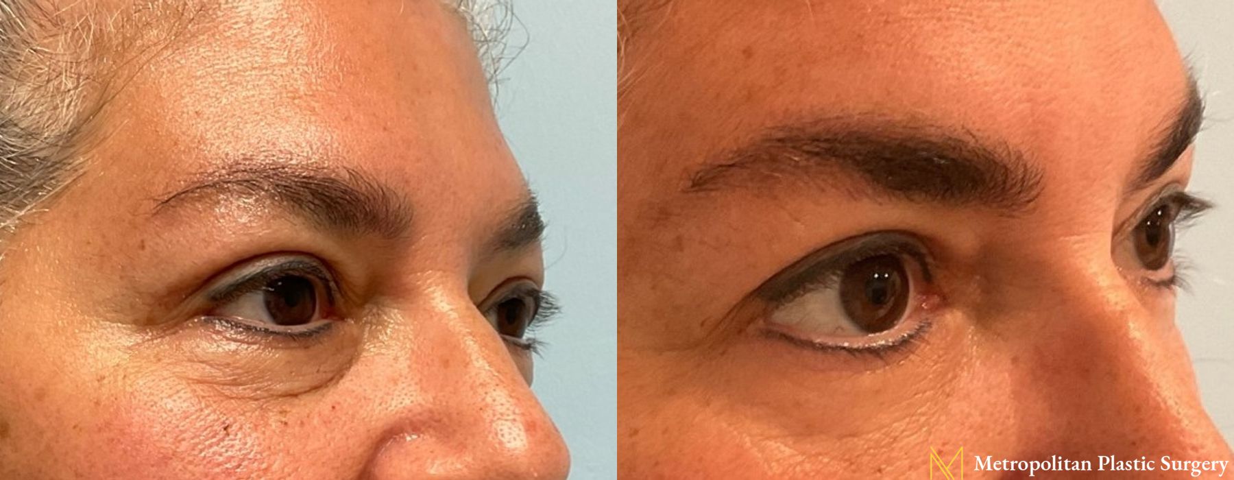 Blepharoplasty - Thumbnail 2