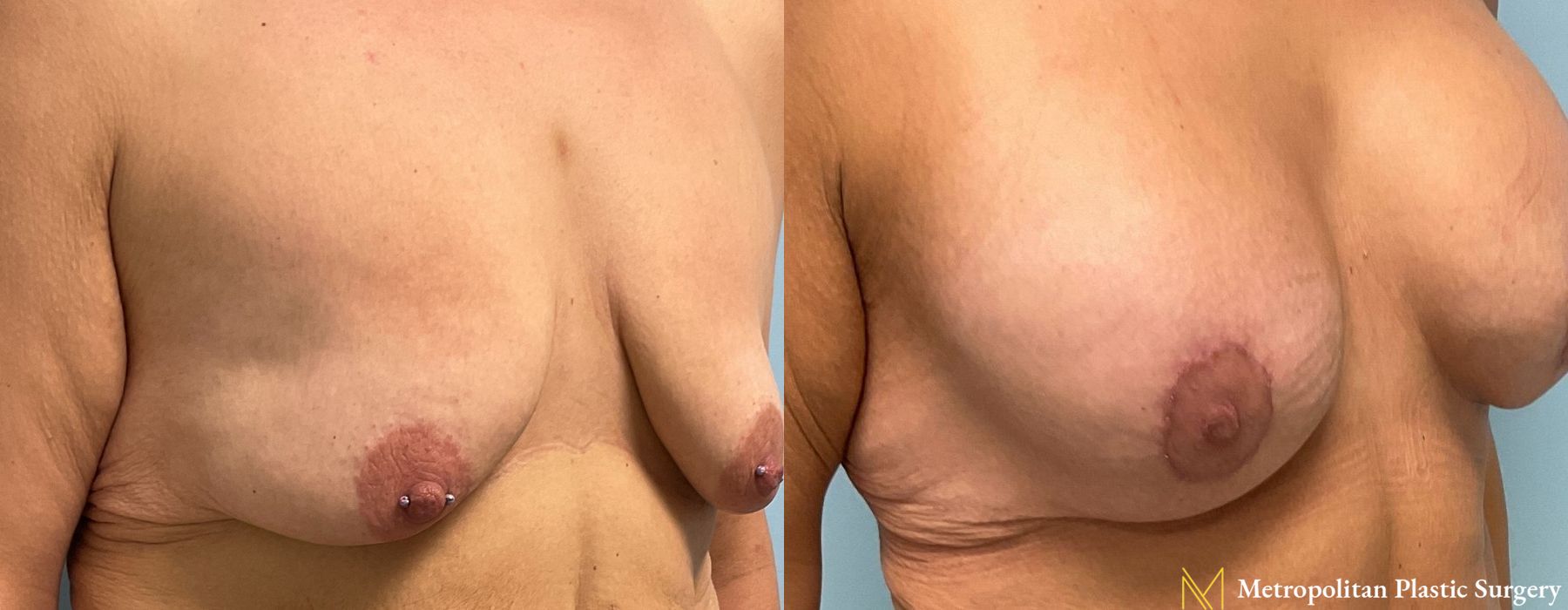 Breast Lift with Implants - Thumbnail 5