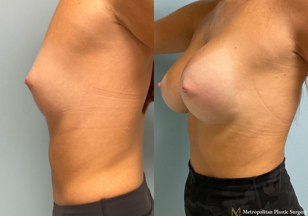 Breast Augmentation - Thumbnail 4