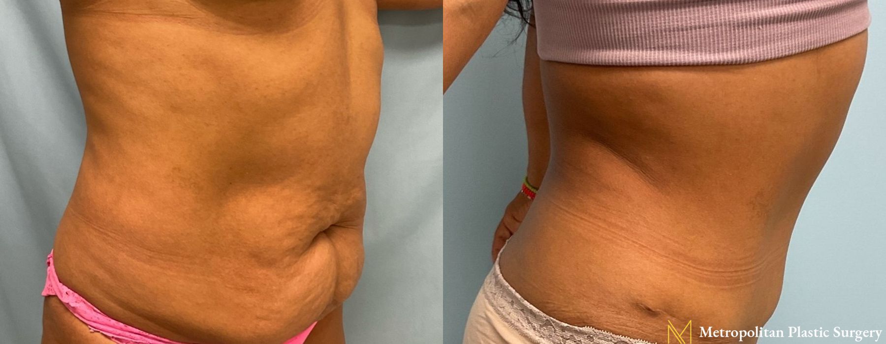 Abdominoplasty - Thumbnail 2