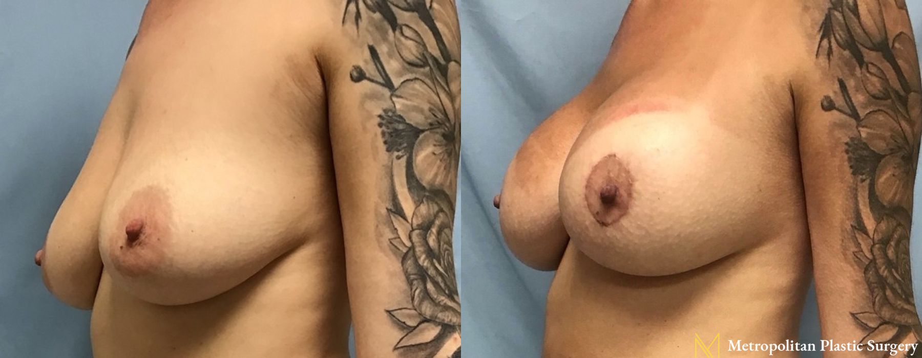 Breast Lift with Implants - Case 102
