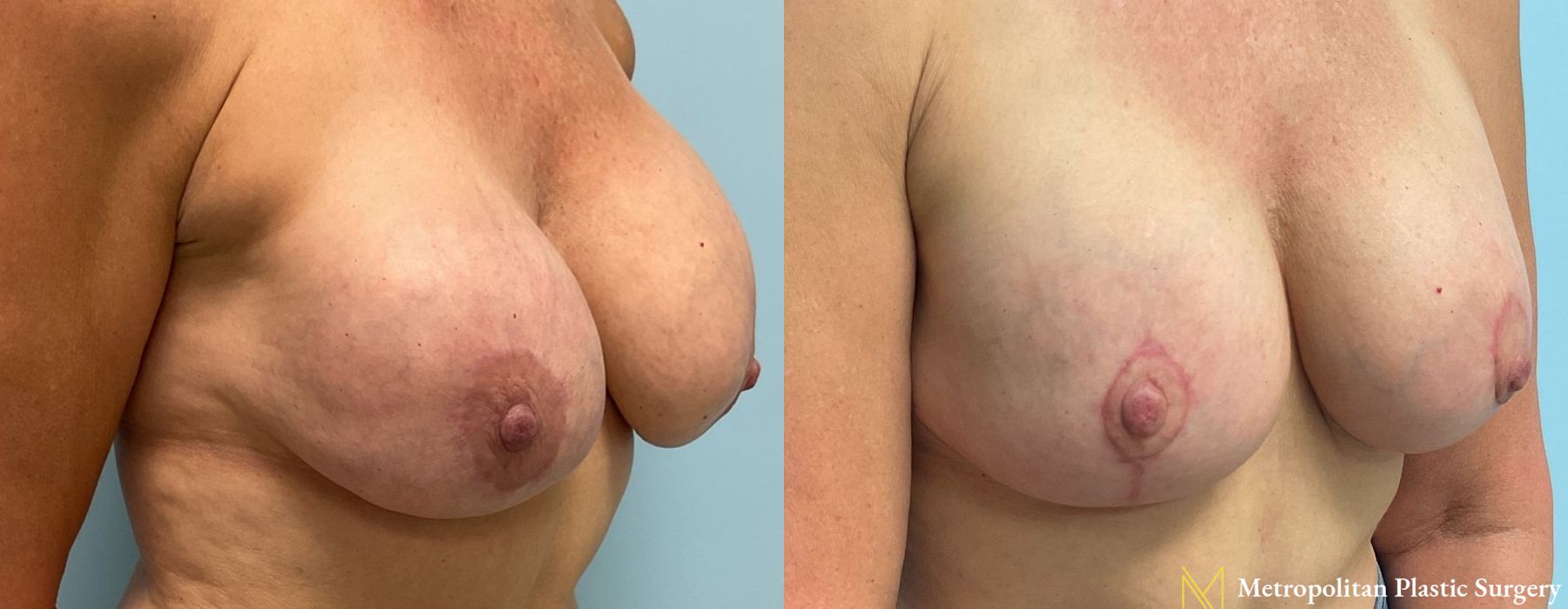 Breast Lift - Thumbnail 3