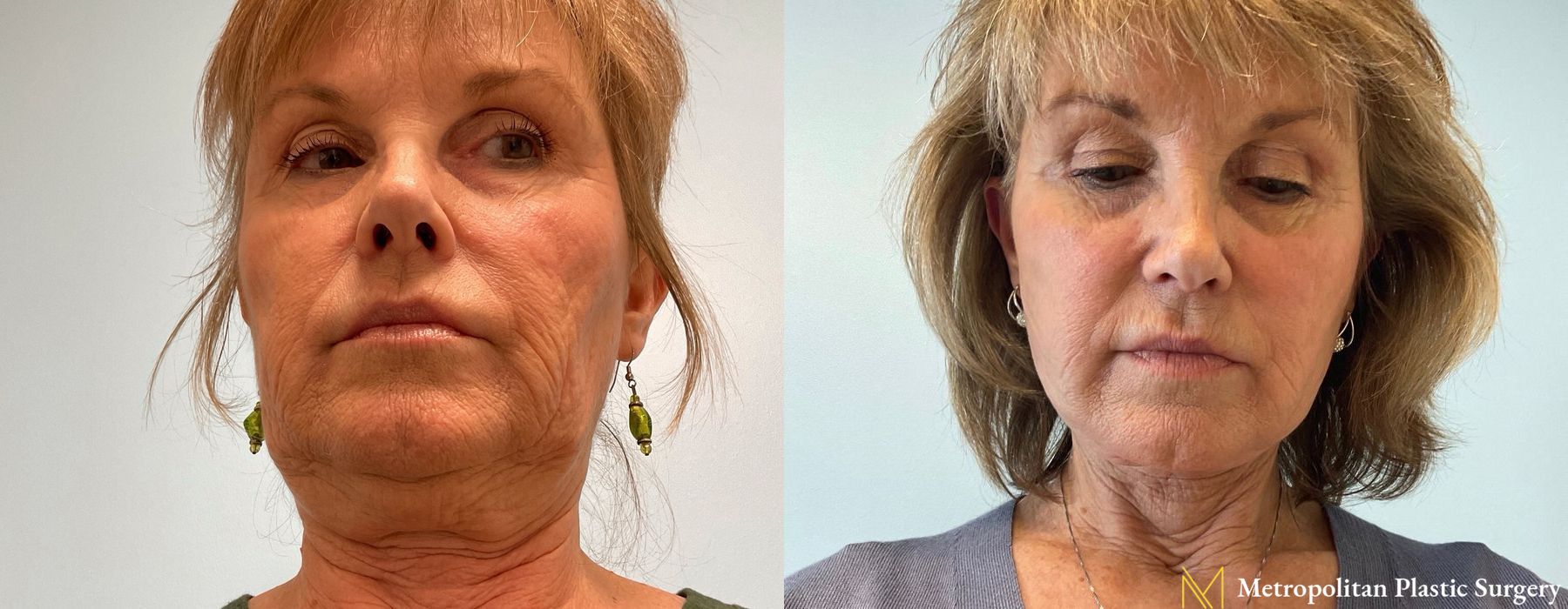 Facelift & Neck Lift - Thumbnail 2