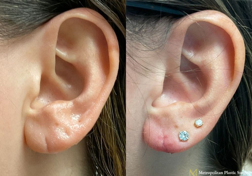 Earlobe Surgery - Case 123