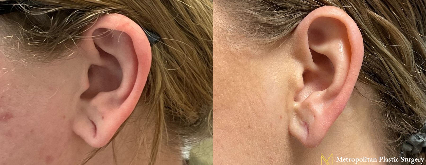 Earlobe Surgery - Case 122