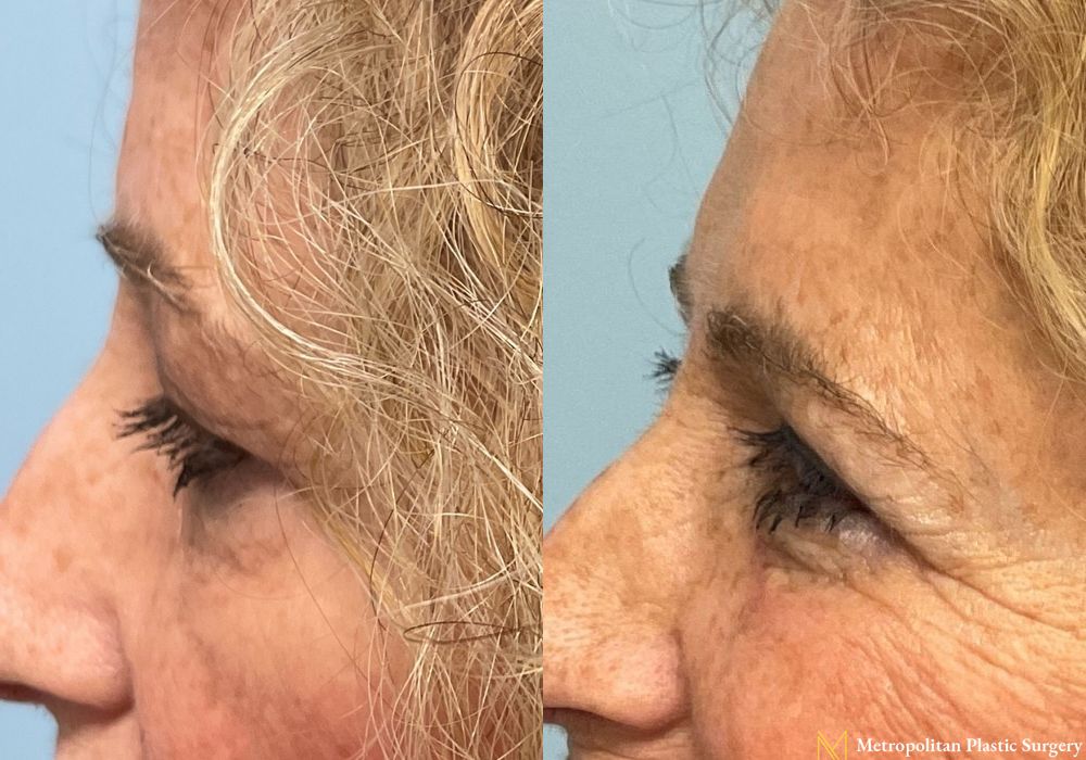 Blepharoplasty - Thumbnail 5