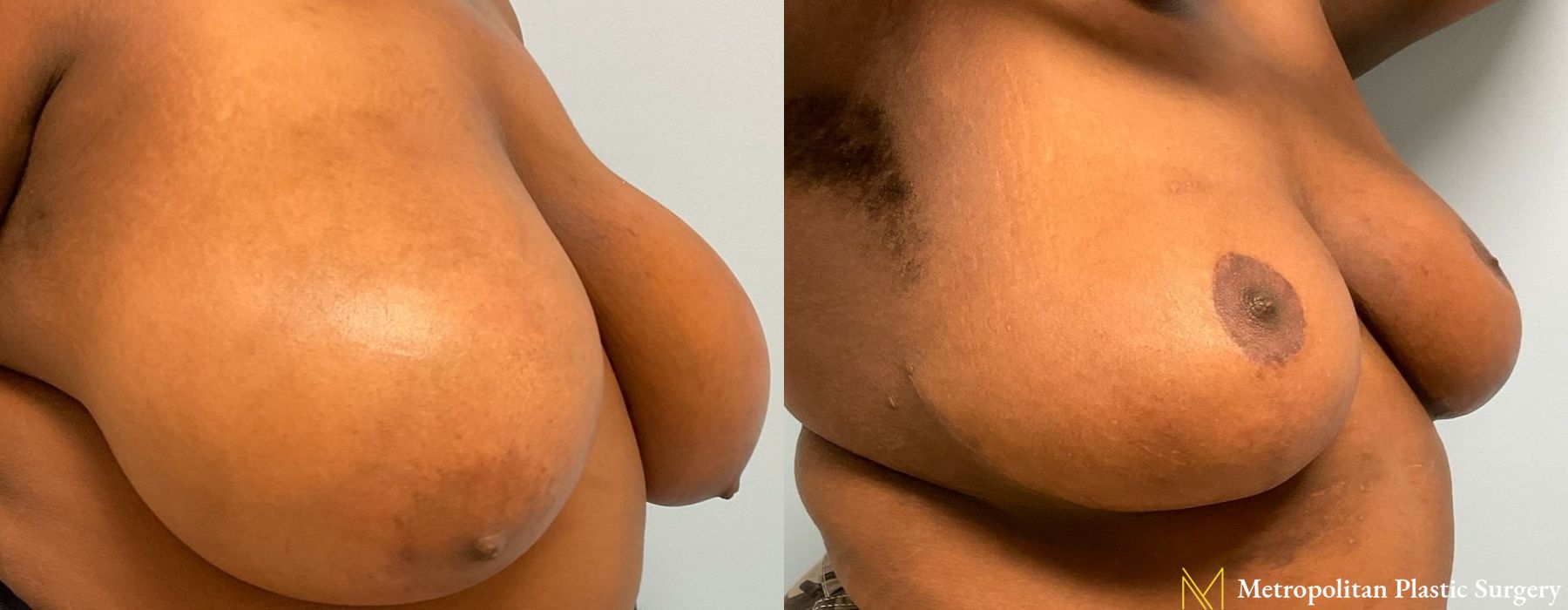 Breast Reduction - Thumbnail 3