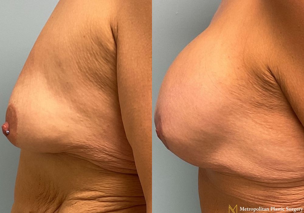 Breast Lift with Implants - Thumbnail 4