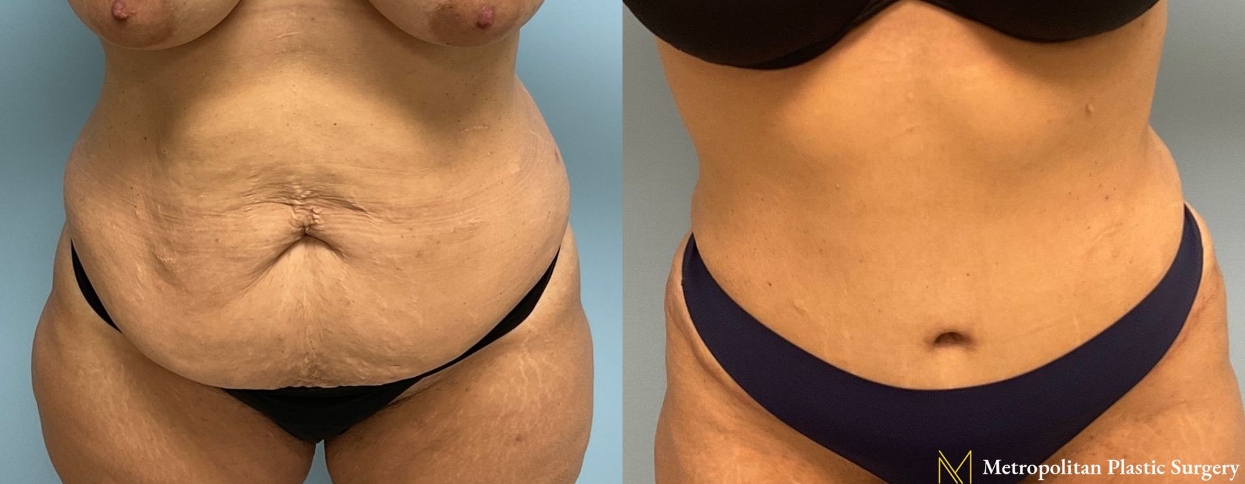 Liposuction - Thumbnail 4