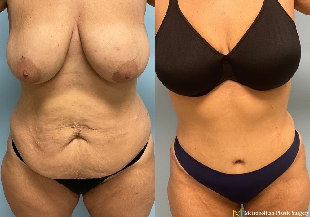 Abdominoplasty - Thumbnail 4