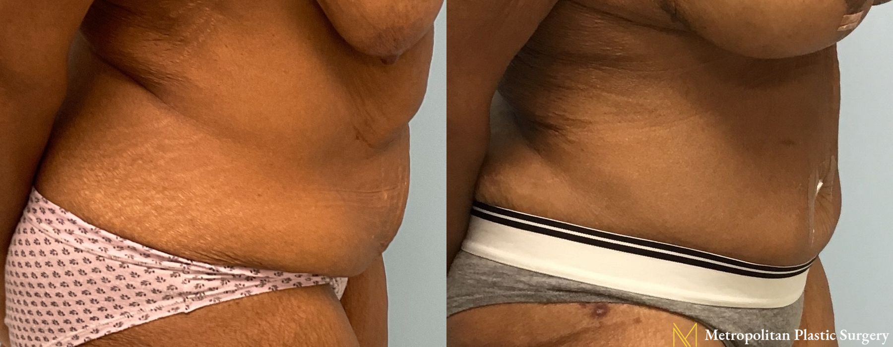 Liposuction - Thumbnail 2