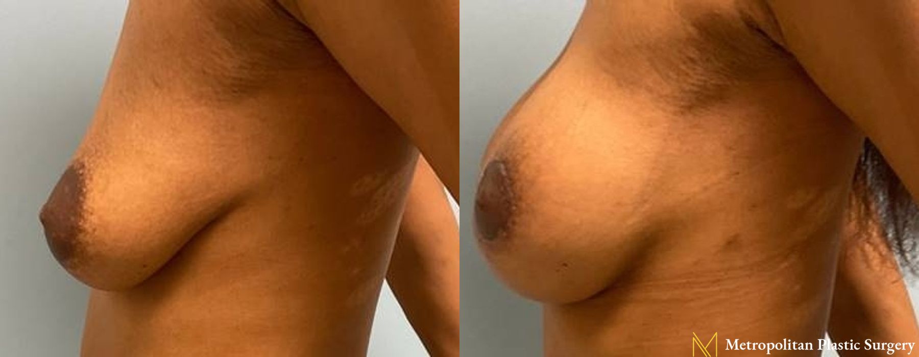 Breast Lift with Implants - Thumbnail 2