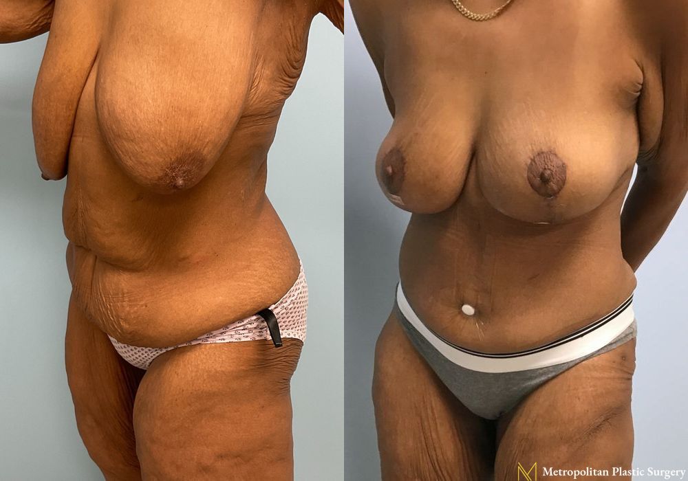 Abdominoplasty - Thumbnail 3