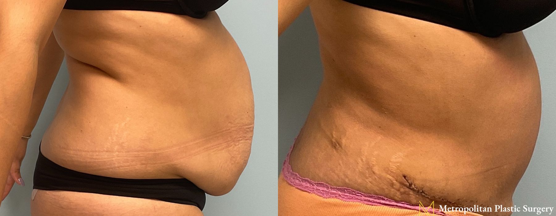 Liposuction - Thumbnail 2