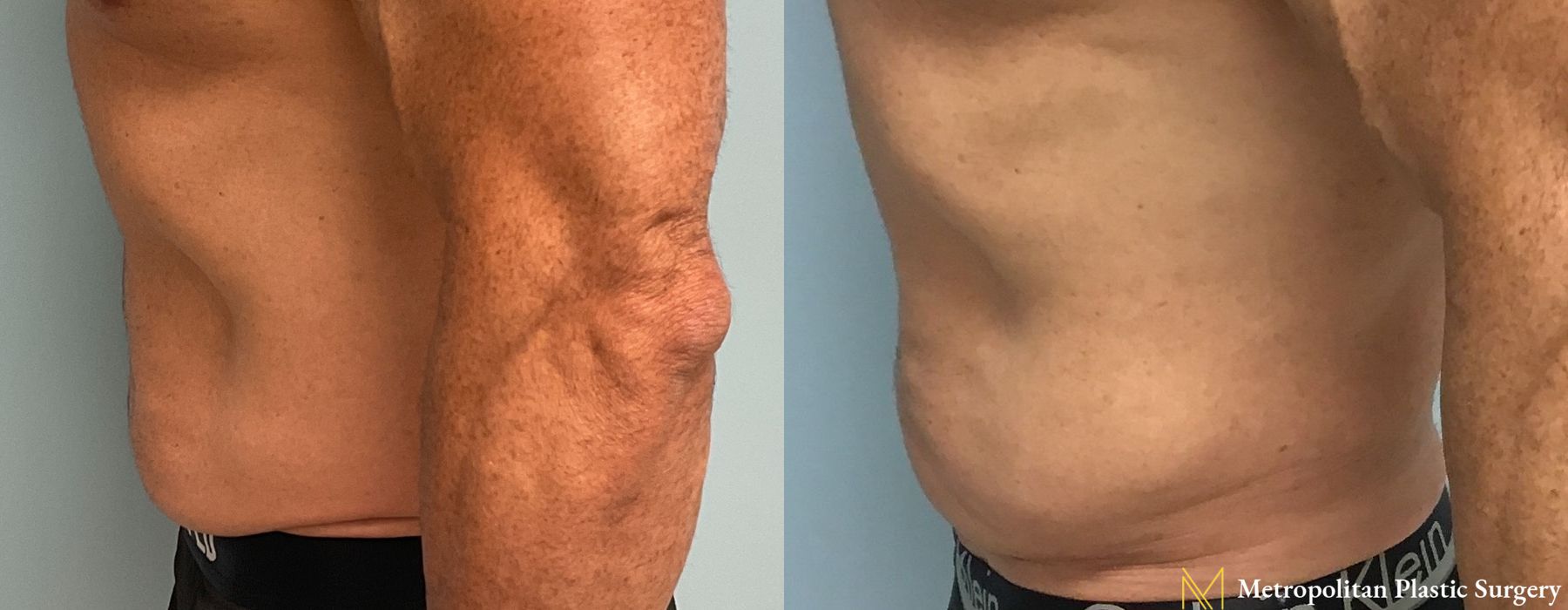 Liposuction - Thumbnail 4