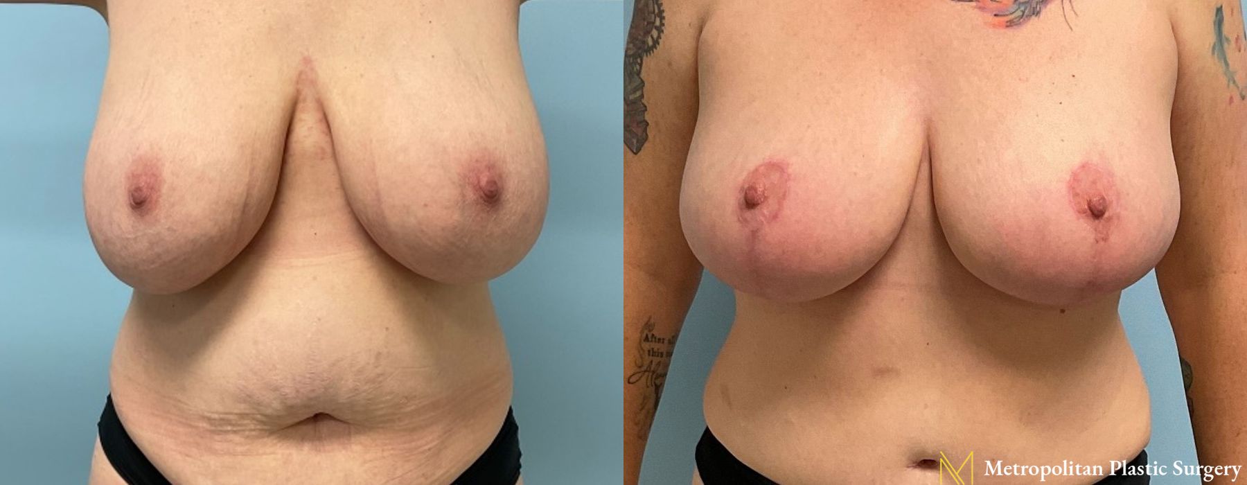 Breast Reduction - Thumbnail 2