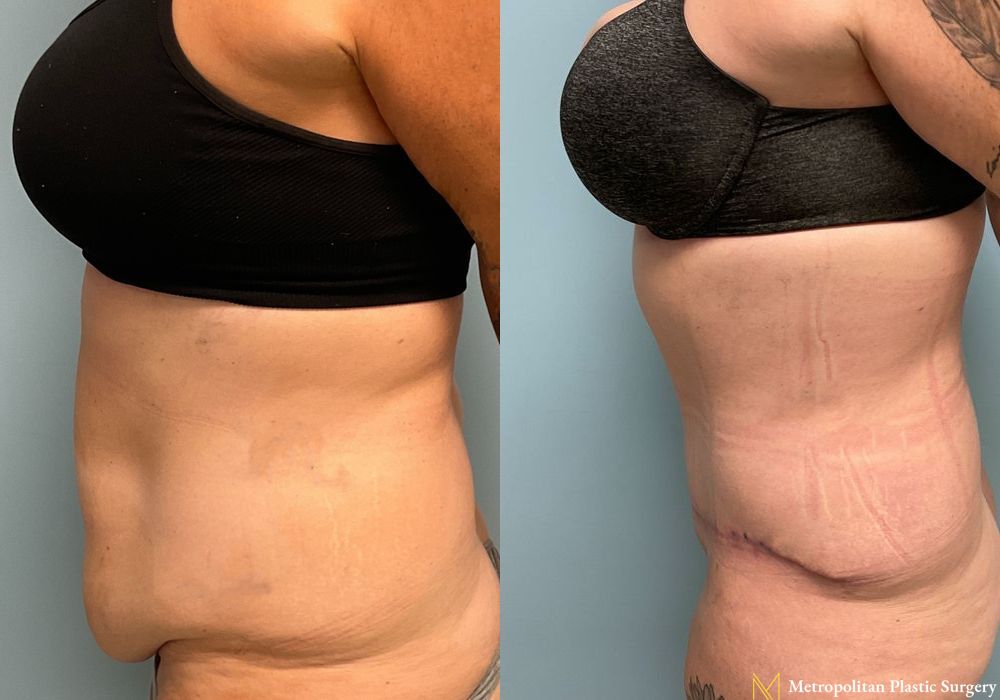 Abdominoplasty - Thumbnail 4