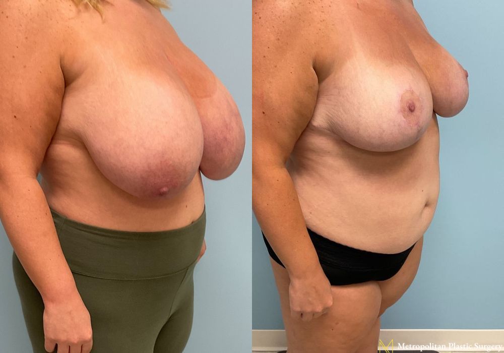 Breast Reduction - Thumbnail 2