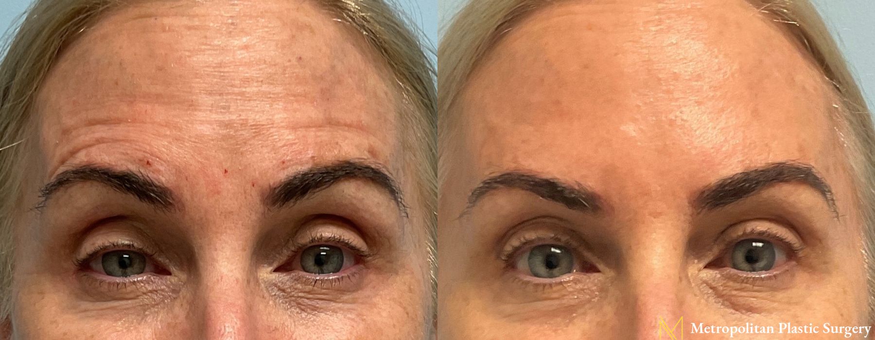 BOTOX® Cosmetic - Thumbnail 2