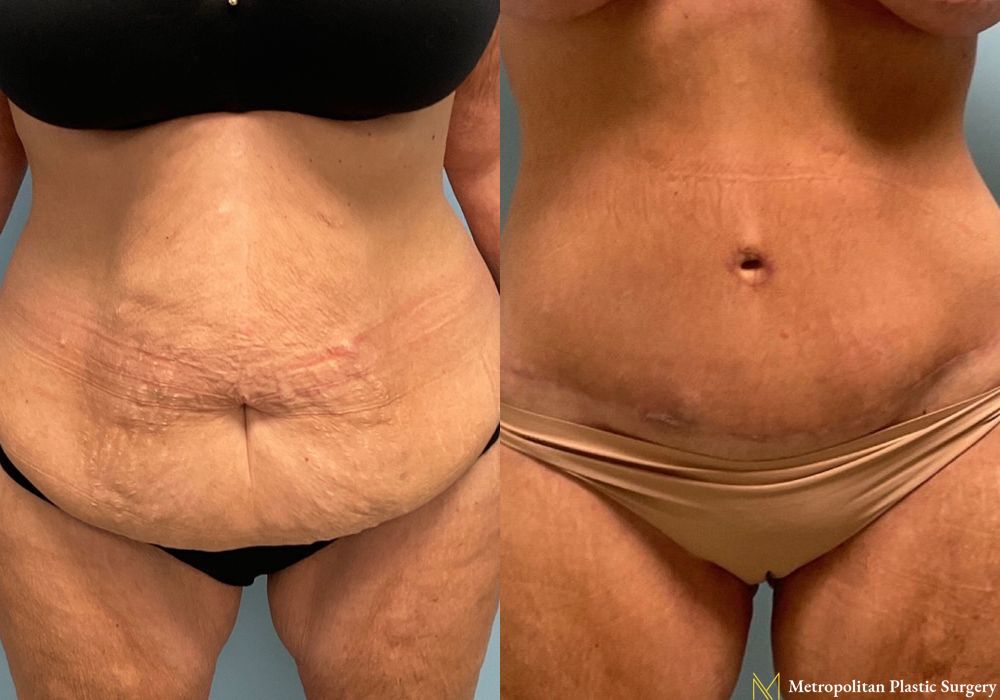 Liposuction - Case 203