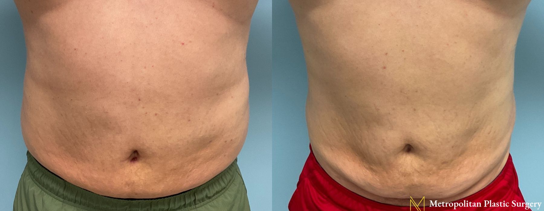 Liposuction - Case 215