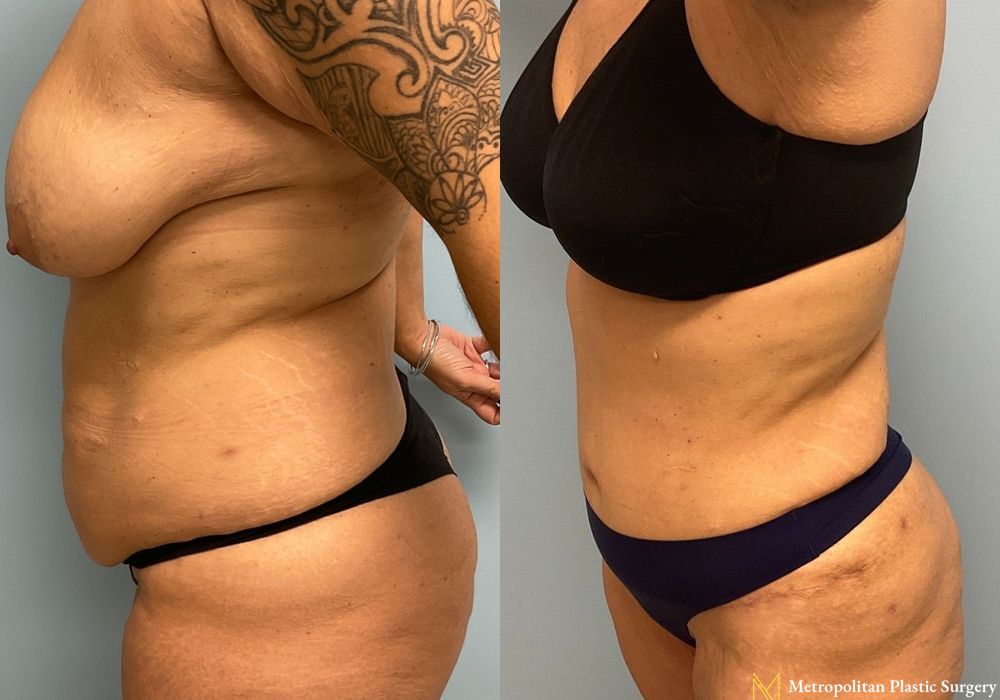 Abdominoplasty - Thumbnail 3