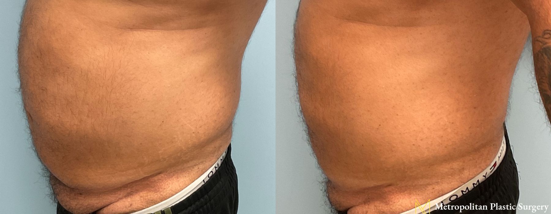 Liposuction - Thumbnail 5