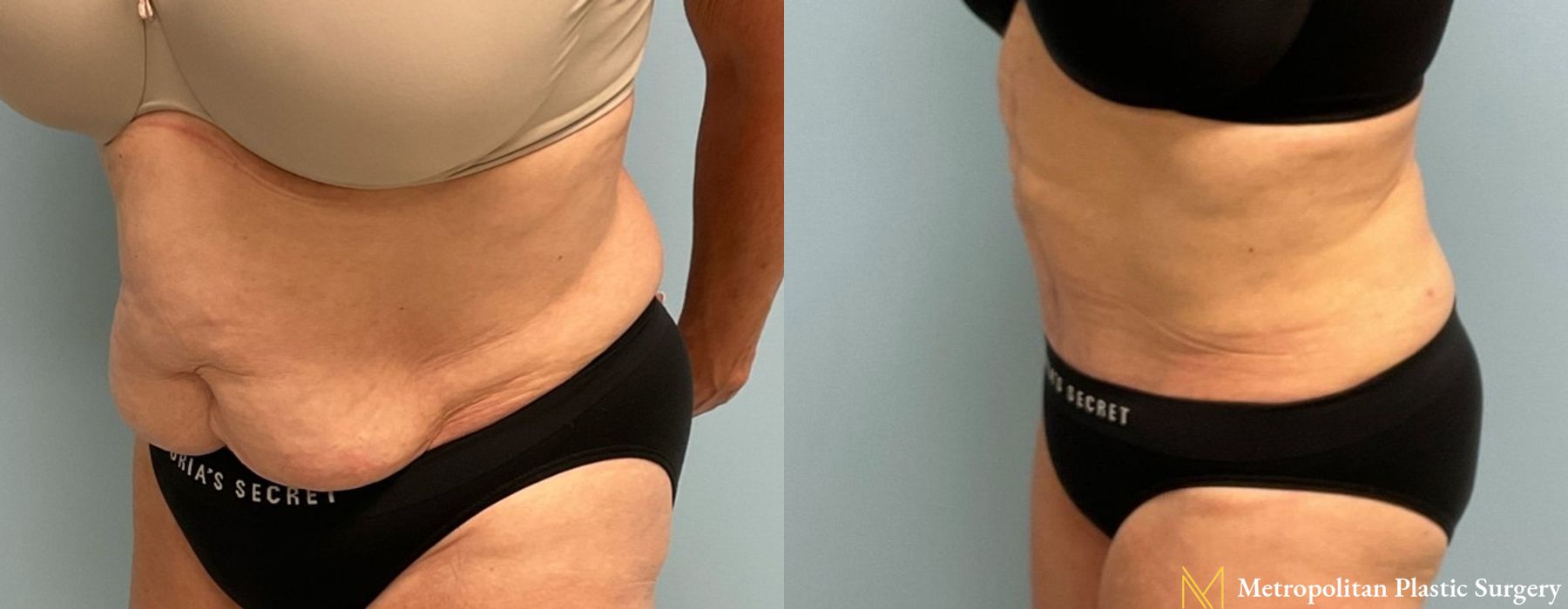 Abdominoplasty - Thumbnail 4