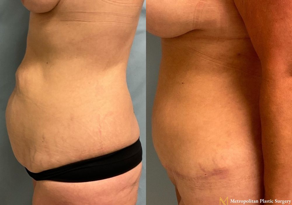 Abdominoplasty - Thumbnail 4