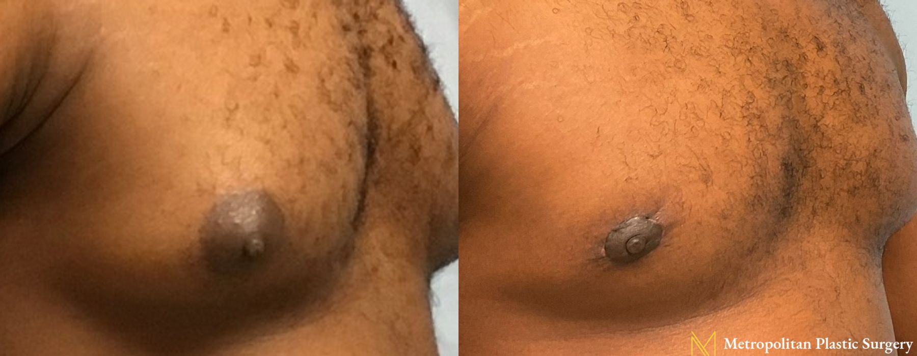 Gynecomastia - Thumbnail 2