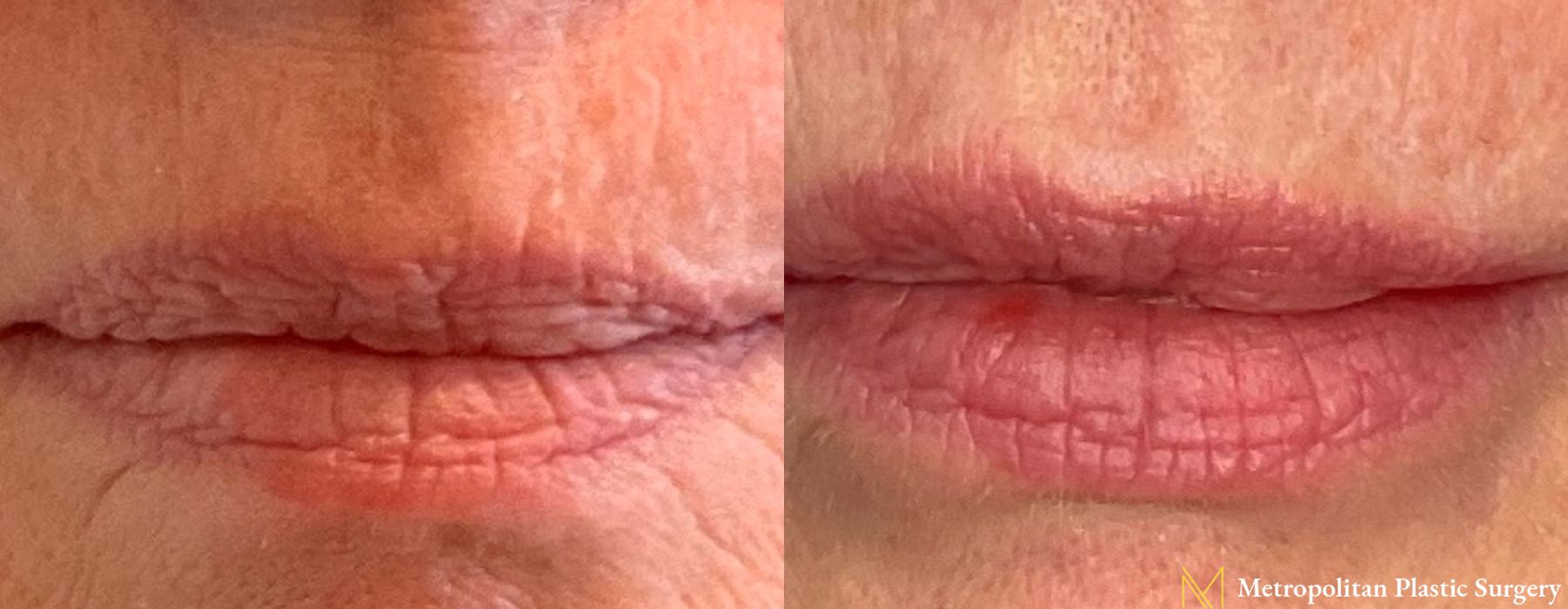 Fillers - Thumbnail 2