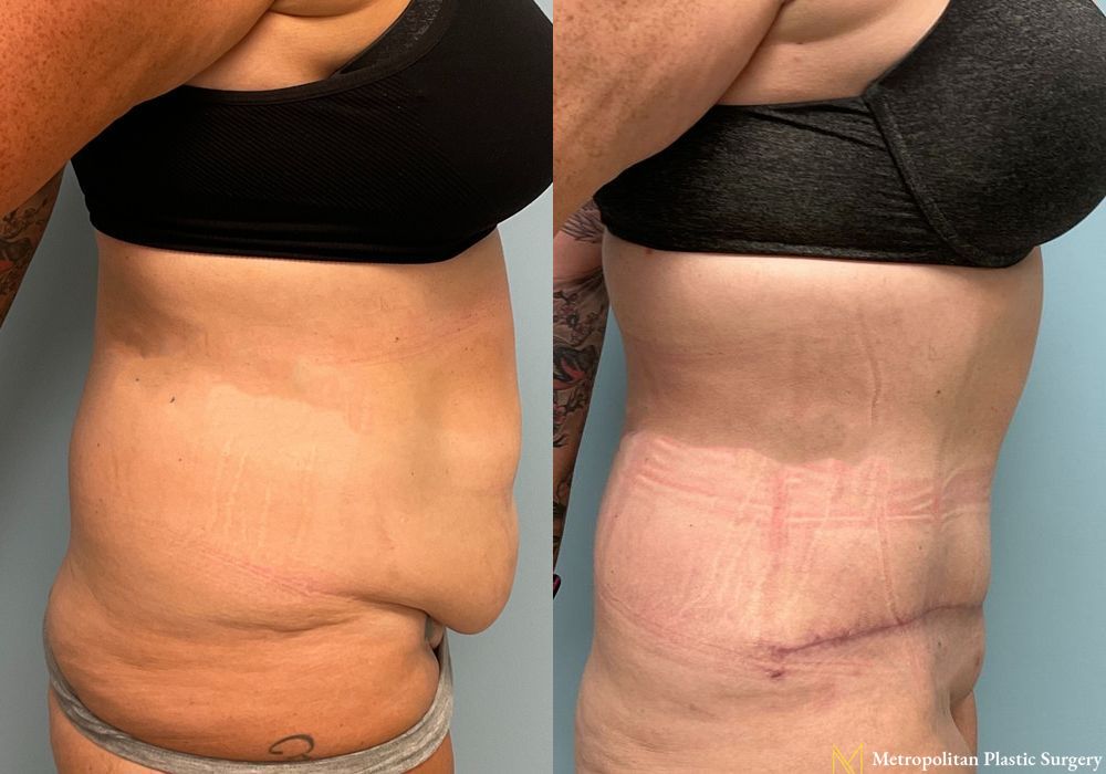 Abdominoplasty - Thumbnail 5