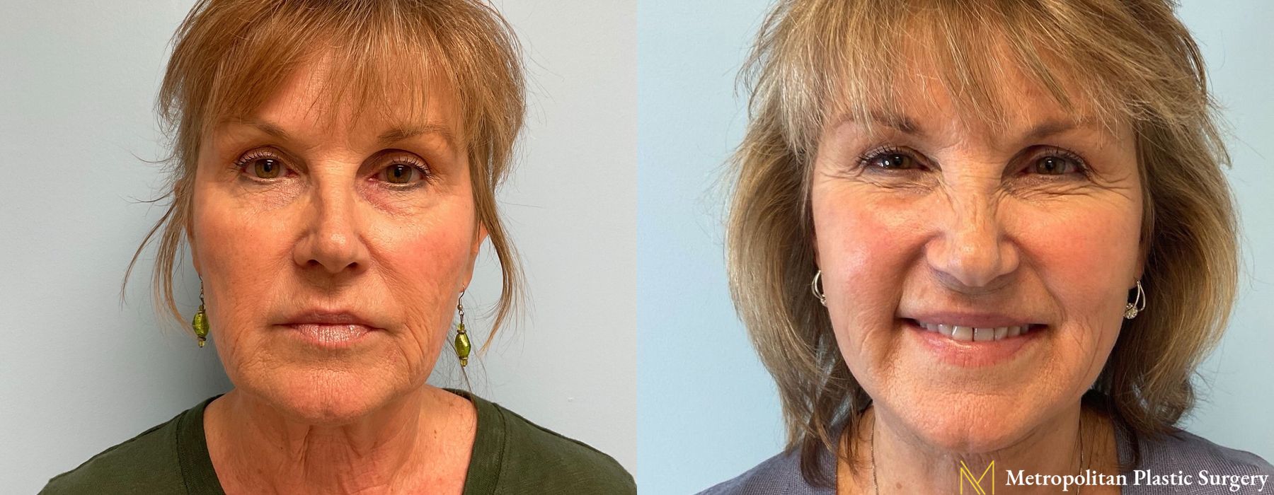 Facelift & Neck Lift - Case 289