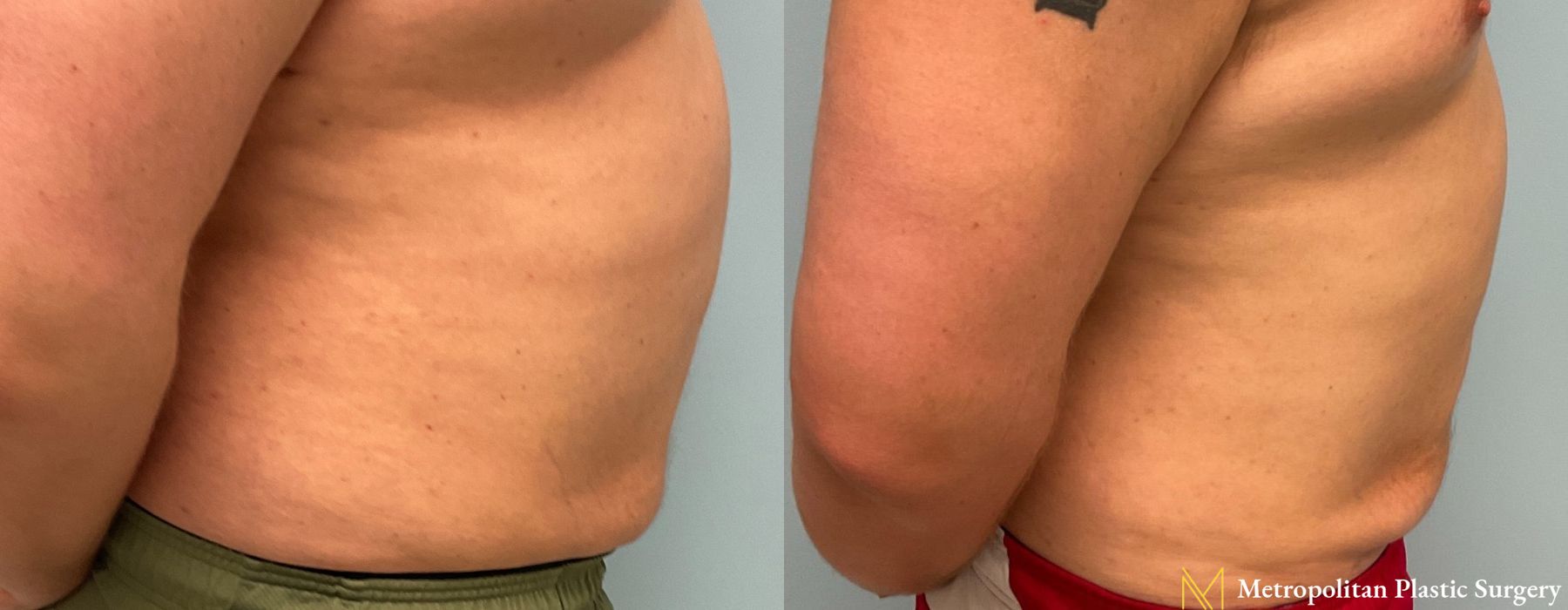 Liposuction - Thumbnail 2