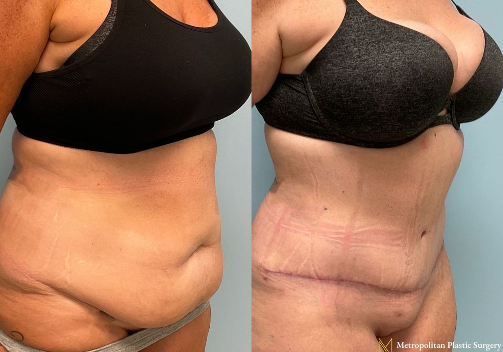 Abdominoplasty - Case 63