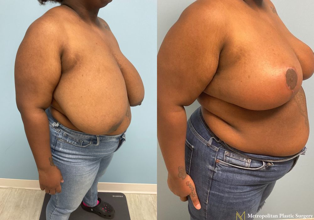 Breast Reduction - Thumbnail 2