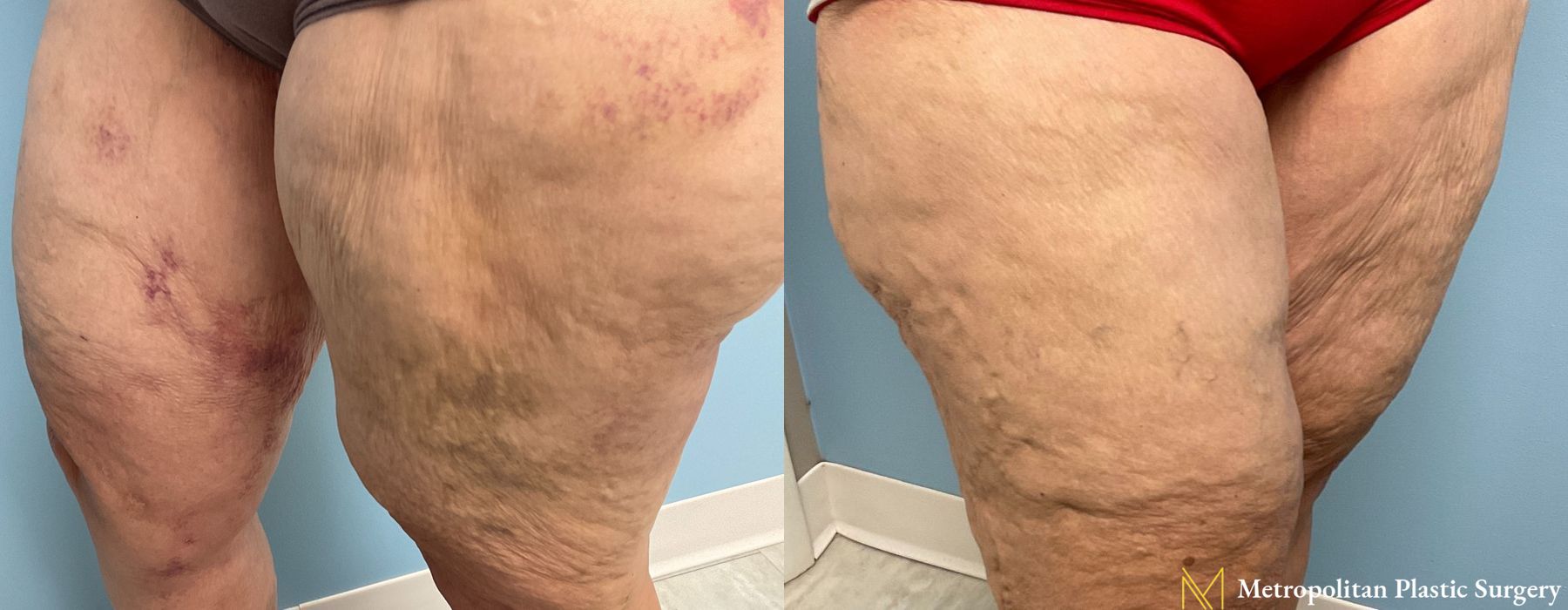 Liposuction - Thumbnail 2