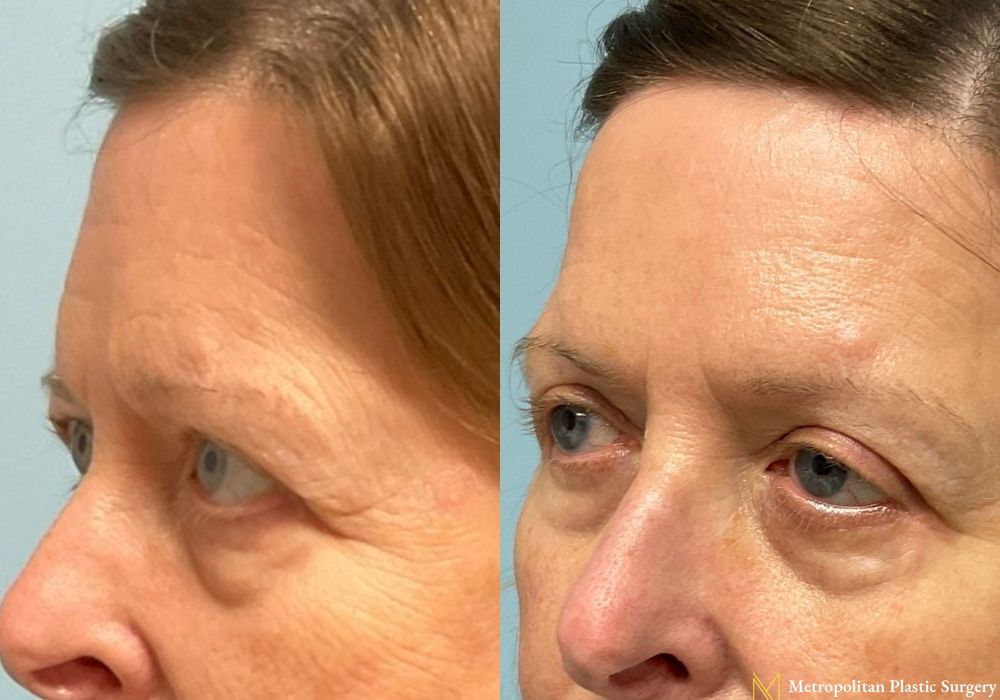 Blepharoplasty - Thumbnail 5