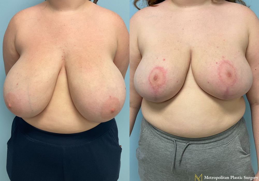 Breast Reduction - Case 111