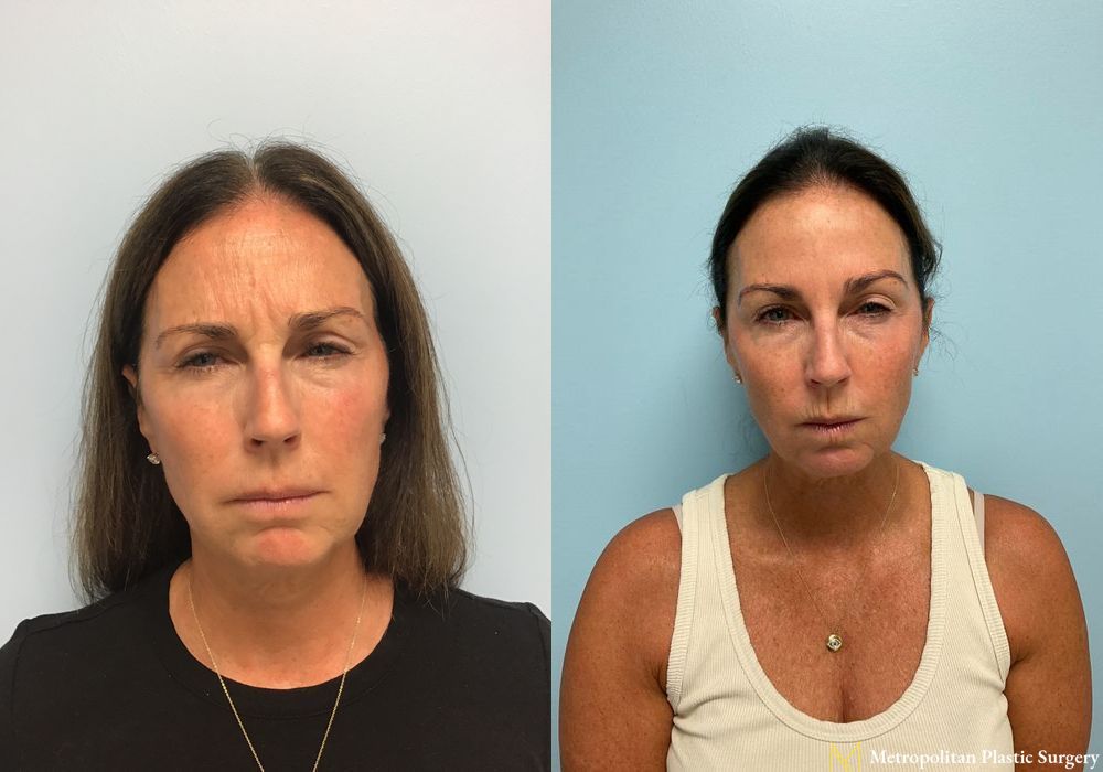 BOTOX® Cosmetic - Thumbnail 2