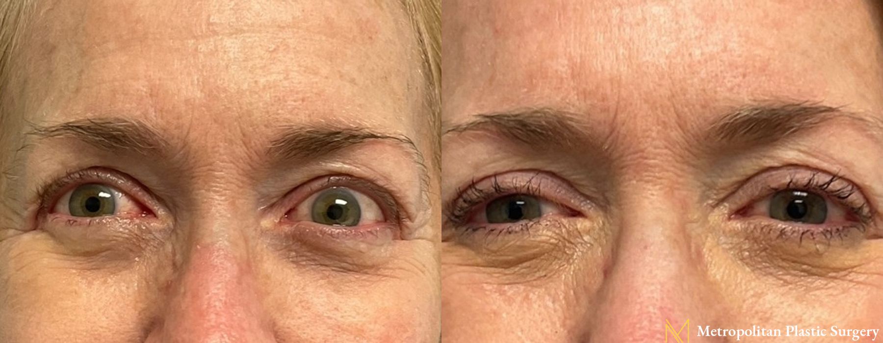 Blepharoplasty - Thumbnail 3