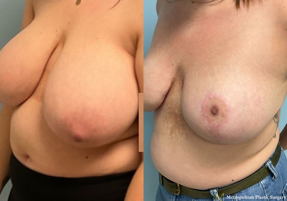 Breast Reduction - Thumbnail 4