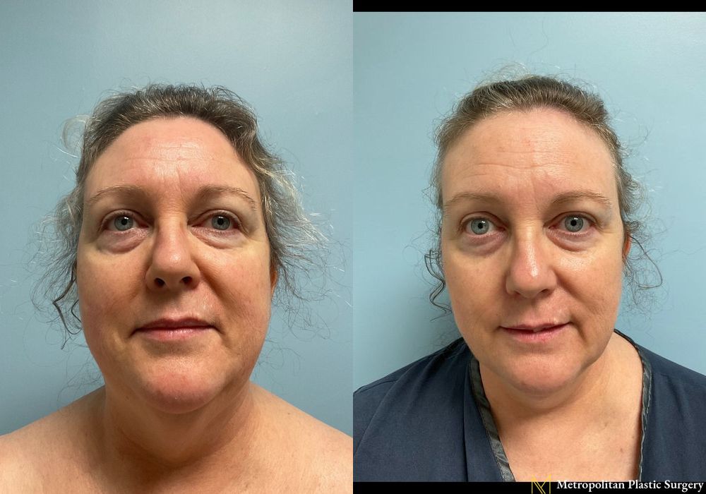 Facelift & Neck Lift - Case 293
