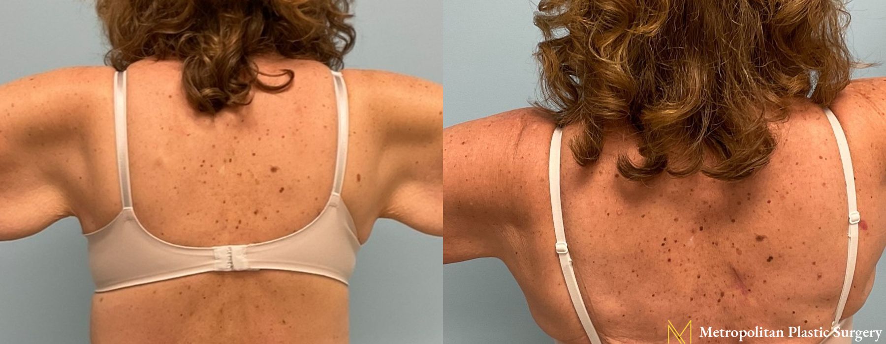 Brachioplasty - Thumbnail 2